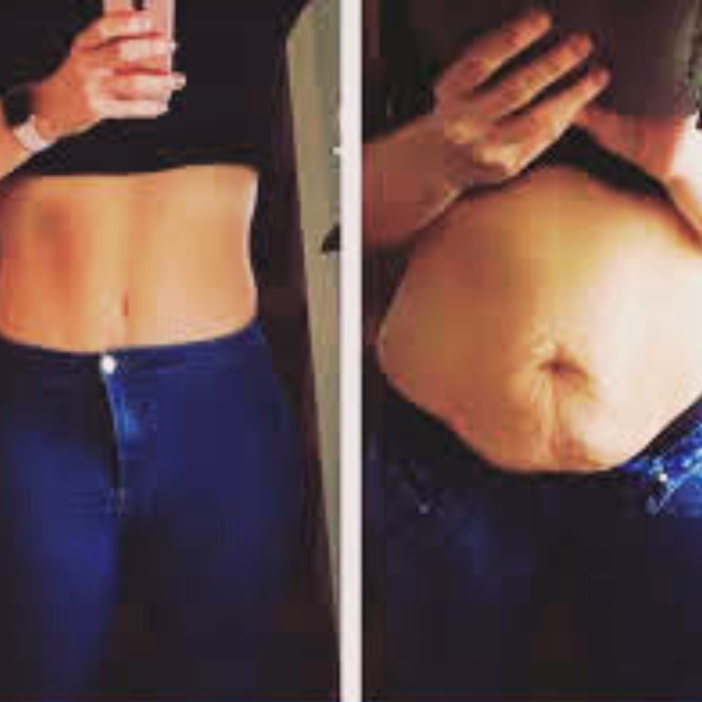 Brazilian Buttlift - Tummy Tuck Recovery: Timeline, Tips, and More!