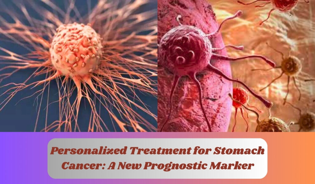 Personalized Treatment for Stomach Cancer